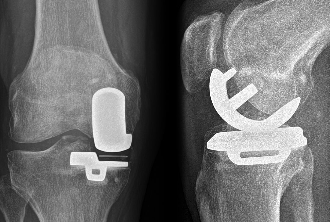 Wann ist Teilprothese sinnvoll? - ortho sport | Coburg & Kronach