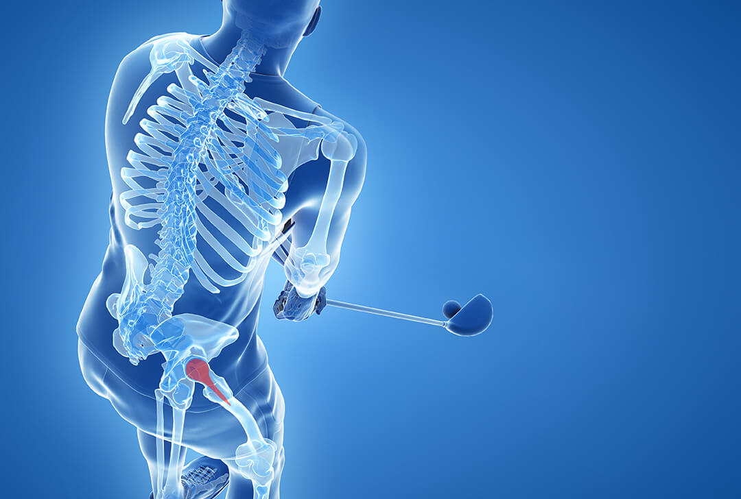 Hüftprothesen - Golfspielen mit künstlichem Gelenk ist möglich.