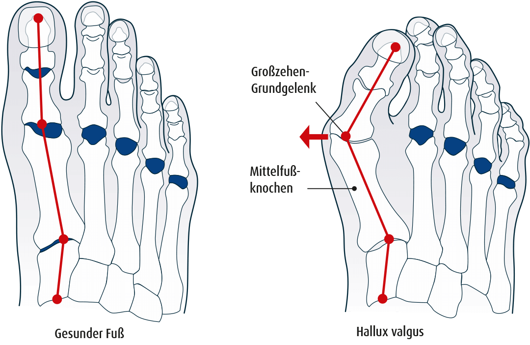 Fehlstellung der Füße - Hallux Valgus